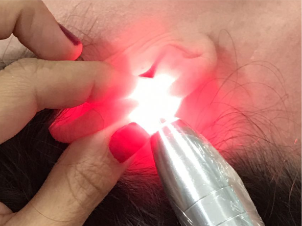 Auriculoterapia com Laser